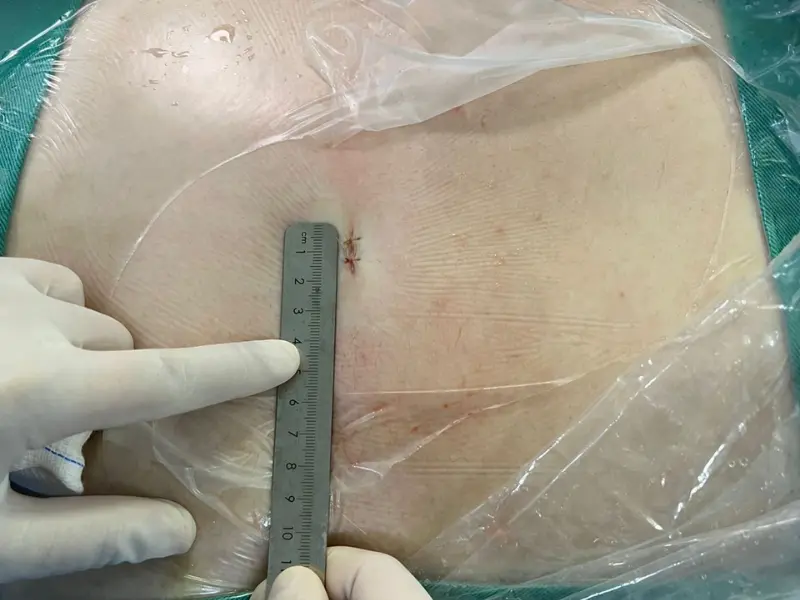 corte-cirurgia-endoscopicana-coluna