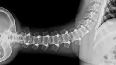 Artropatia facetária