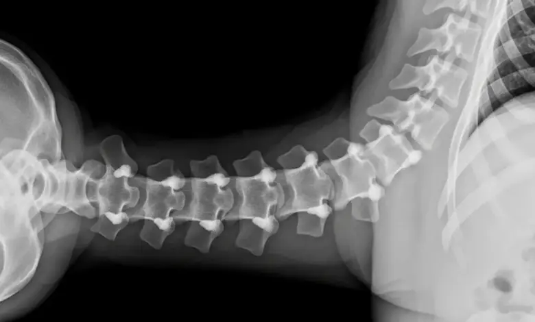 Artropatia facetária