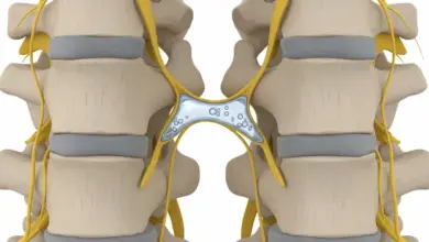 Cisto facetário da coluna