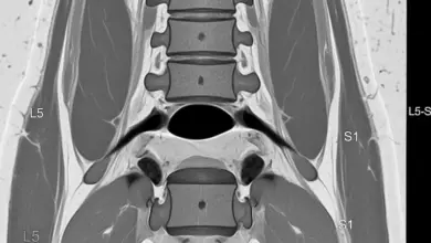 Discopatia degenerativa L5 S1 com protusão discal