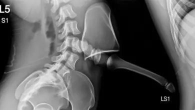 Espondilolistese displásica