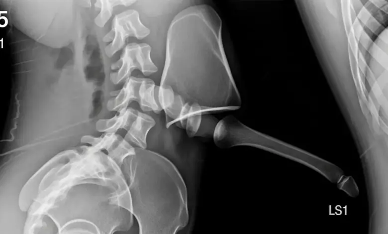 Espondilolistese displásica