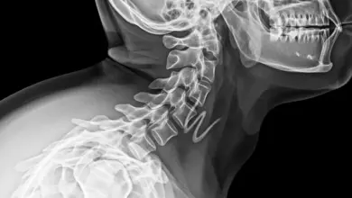 Síndrome de Klippel-Feil