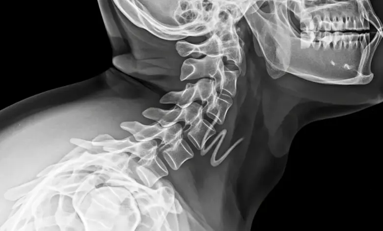 Síndrome de Klippel-Feil