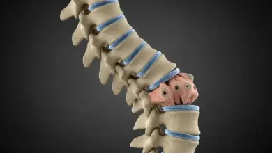 Escoliose degenerativa