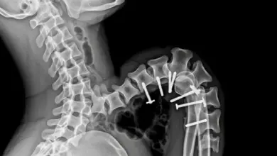 Cifose pós-traumática