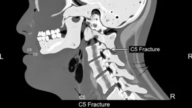 Como ocorre a fratura da coluna cervical