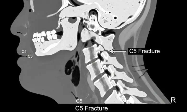 Como ocorre a fratura da coluna cervical
