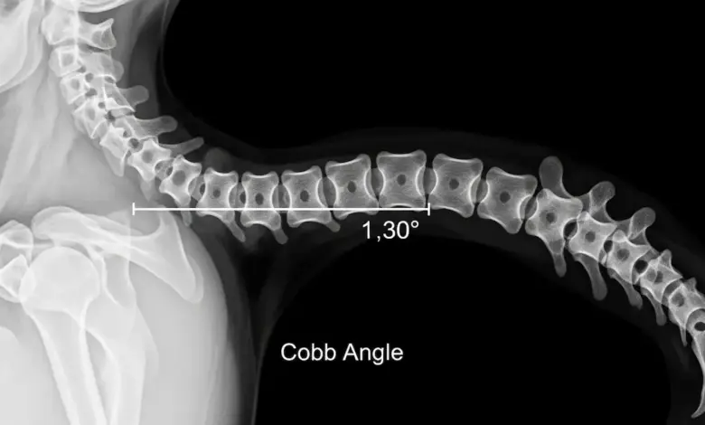 Como saber se tenho cifose