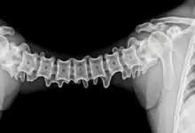 Hiperostose esquelética idiopática difusa