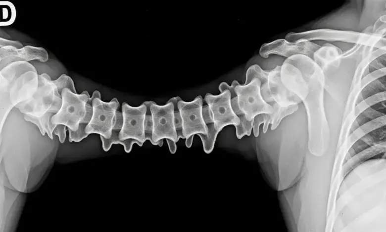 Hiperostose esquelética idiopática difusa