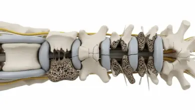 Osteoporose na coluna aposenta