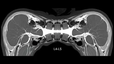 Tratamento para estenose lombar