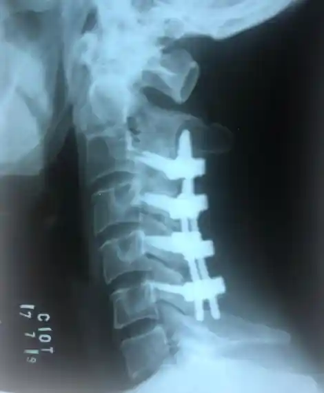 Coluna vertebral - fusão vertebral por artrodese
