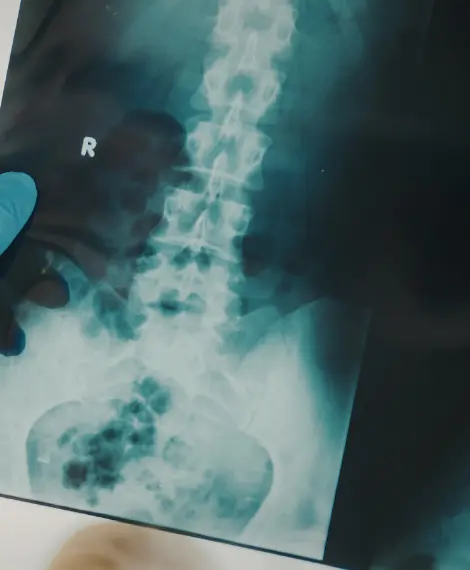 Desvio de coluna e coluna torta tratamento em Goiânia com Dr. Aurélio Arantes