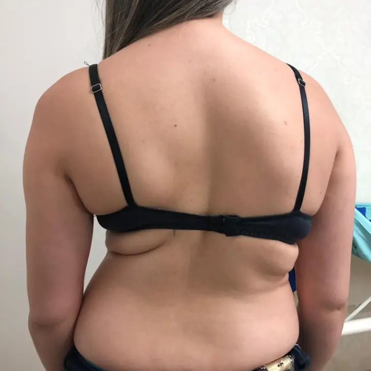 Escoliose - deformidade da coluna vertebral