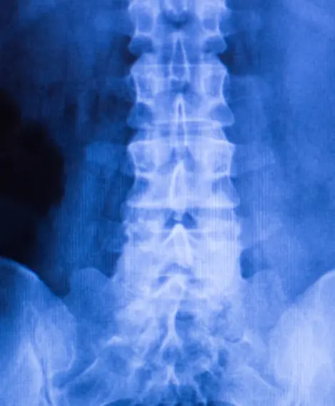 Ortopedista especialista em vertebroplastia percutânea em Goiânia