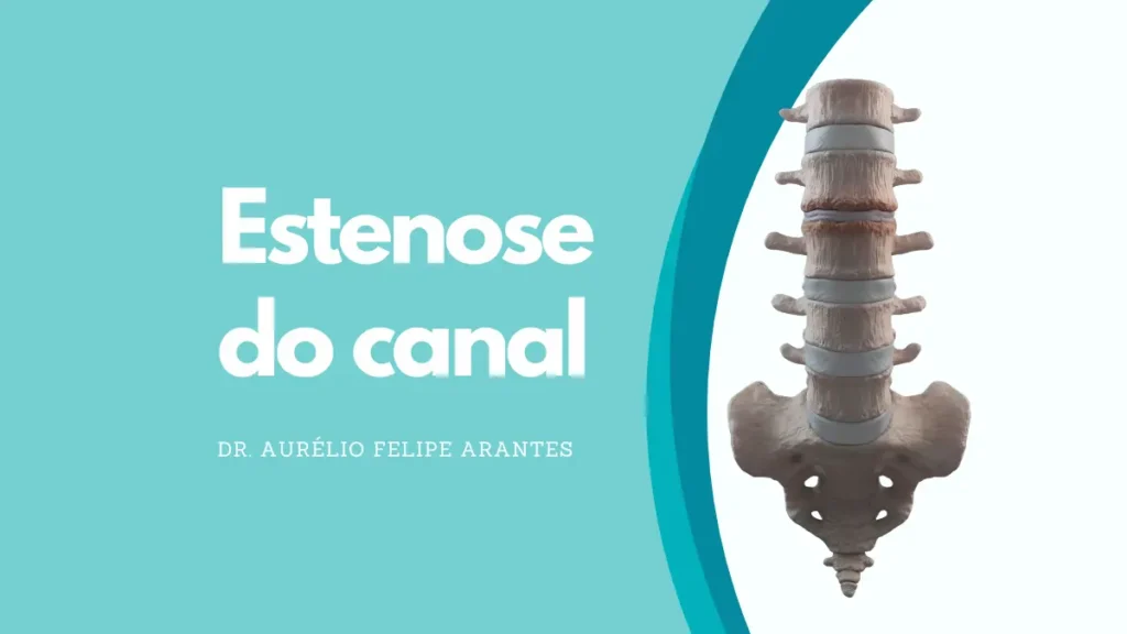 Estenose Do Canal Doenca Pode Afetar Coluna Lombar E Cervical