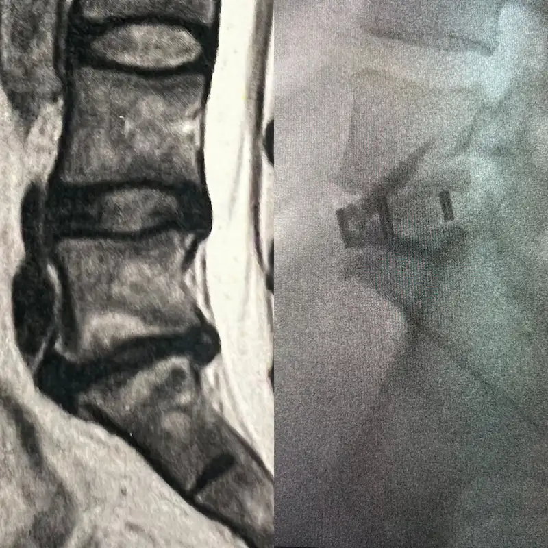 Técnica Alif (Anterior Lumbar Interbody Fusion) Sem Parafuso