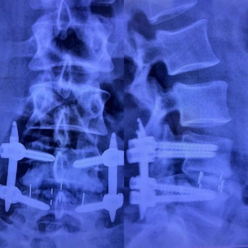 Técnica Olif (Oblique Lumbar Interbody Fusion)