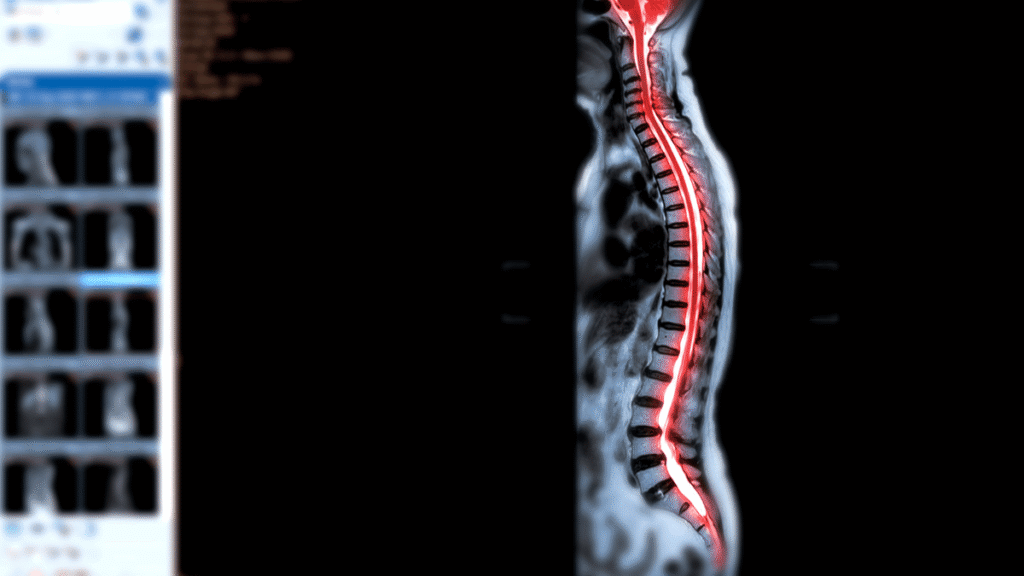 Cirurgia de Laminectomia