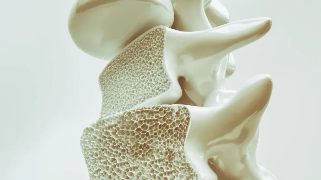 Osteoporose na coluna é grave?
