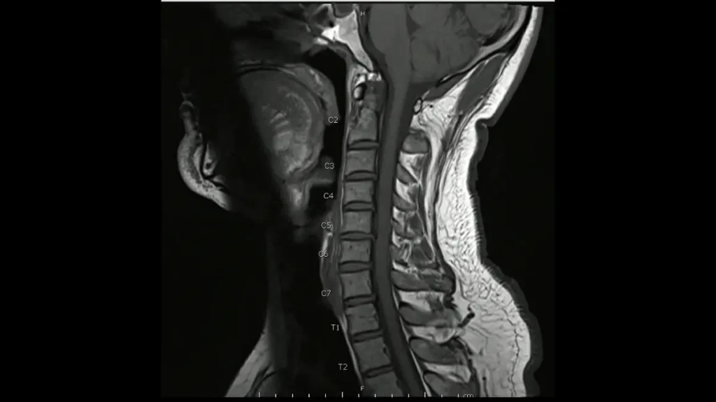 Cirurgia de deformidade cervical