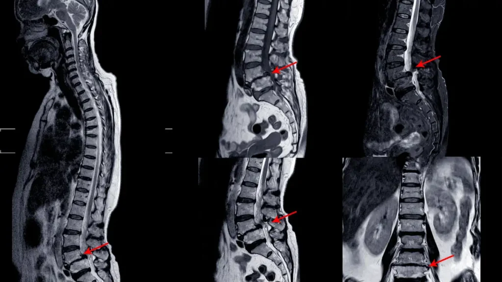 Espondilodiscoartrose cervical em C5 C6